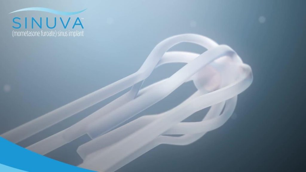 SINUVA implant for nasal polyps