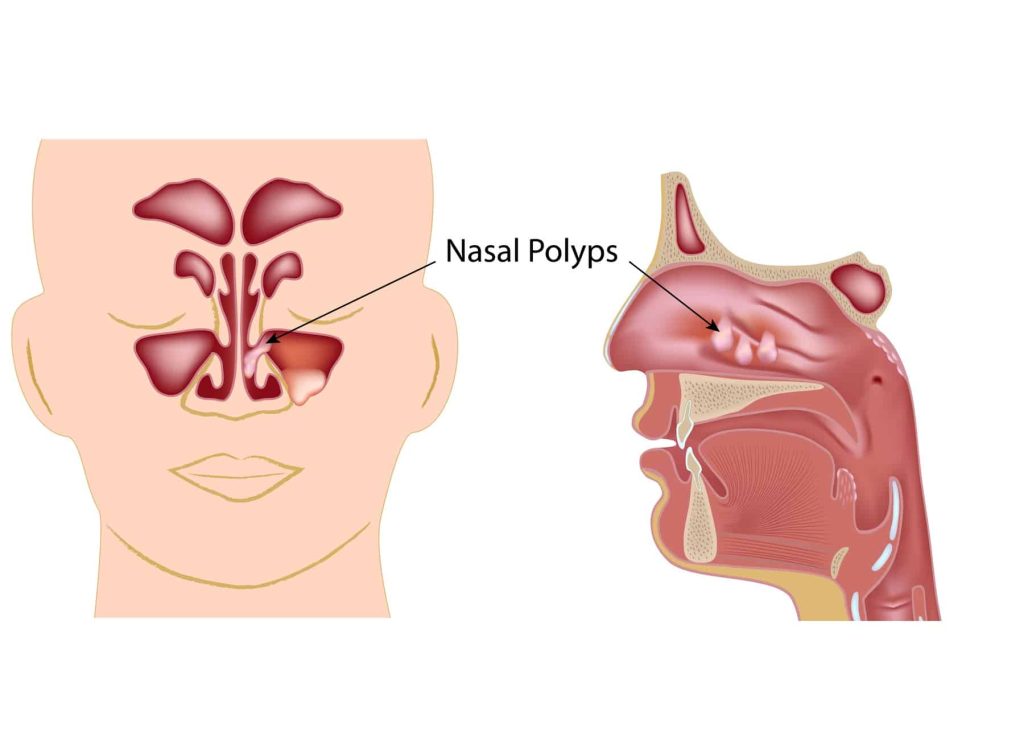 illustration of nasal polyps in the sinuses